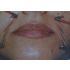 Acupuntura no Bigode Chinês