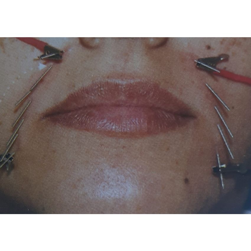 Acupuntura no Bigode Chinês